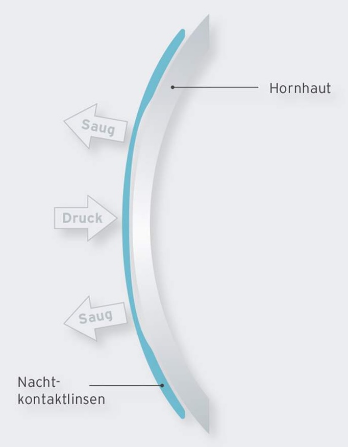 traumlinsen technologie2